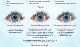 Conjuntivitis - Infograf&iacute;a
