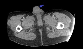 Hallazgo de necrosis genital debido a uso de cocaína en la vena dorsal de órgano masculino