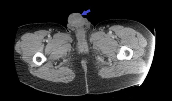 Hallazgo de necrosis genital debido a uso de cocaína en la vena dorsal de órgano masculino