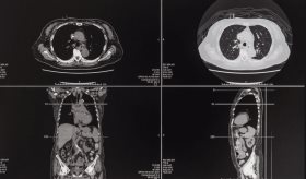 Rara variante genética de autismo se descubre en Puerto Rico