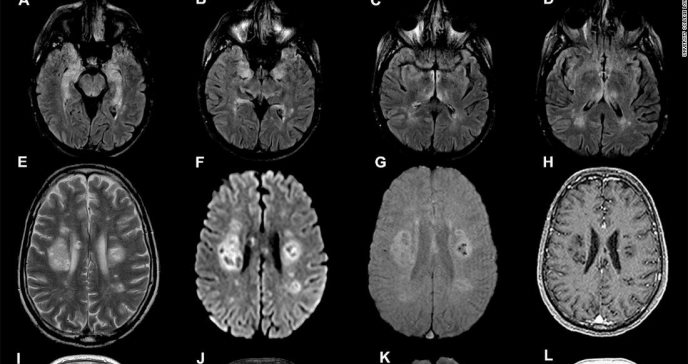 Más evidencia: la niebla mental de Covid-19 tiene base neurológica