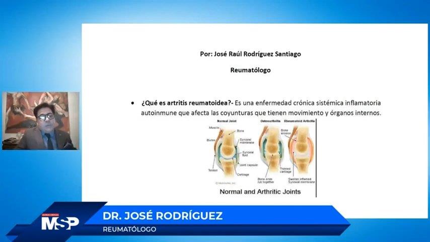 Artritis reumatoide: una descripción general