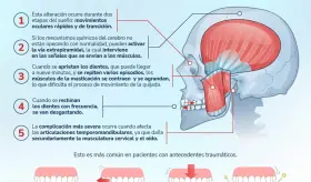 Bruxismo - Infografía