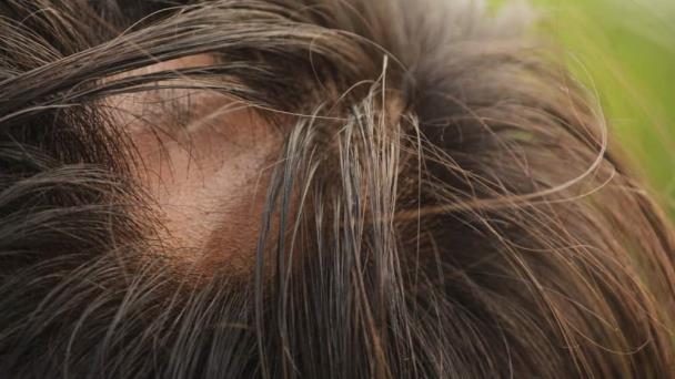 Nuevo estudio evalúa prevalencia de la alopecia areata pediátrica basándose en su información demográfica Nuevo estudio evalúa prevalencia de la alopecia areata pediátrica basándose en su información demográfica