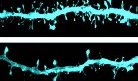 Los cerebros con párkinson presentan cambios funcionales antes de desarrollar los síntomas