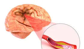 El frío puede aumentar el riesgo de accidente cerebrovascular: conoce los síntomas y cómo prevenirlo