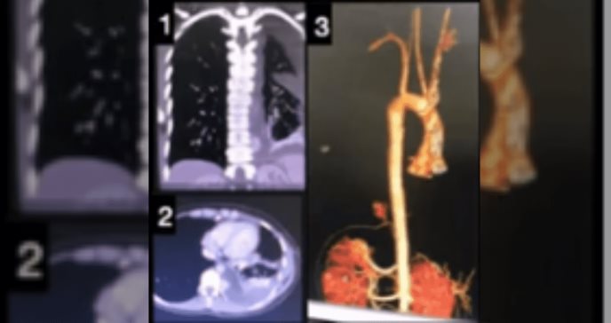 Hallado hemotórax secundario a tumor paraganglioma en malformación arteriovenosa en paciente de la isla