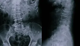 FDA aprueba Upadacitinib como tratamiento oral para adultos con espondilitis anquilosante