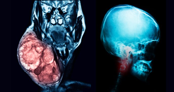 Según estudios, las mutaciones genéticas serían objetivo terapéutico para cánceres en cabeza y cuello