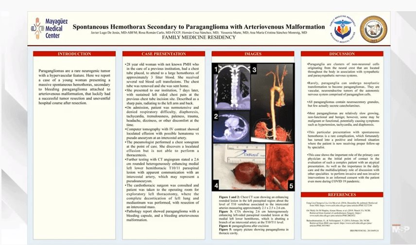 Hallado hemotórax secundario a tumor paraganglioma en malformación arteriovenosa en paciente