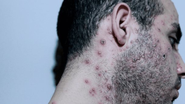 Viruela del mono: detectada en saliva, semen y otras muestras de pacientes infectados Viruela del mono: detectada en saliva, semen y otras muestras de pacientes infectados