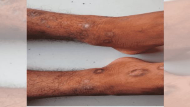 Reportan rara asociación entre lupus eritematoso y eosinofilia Reportan rara asociación entre lupus eritematoso y eosinofilia