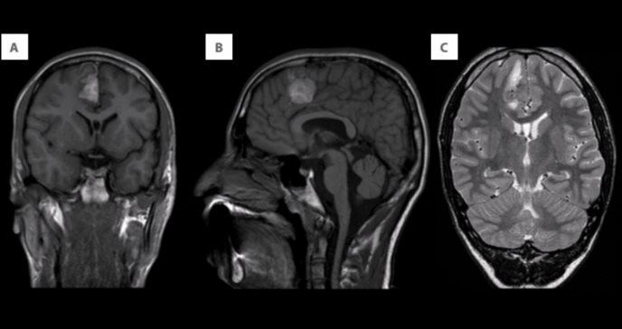 Paciente pediátrico puertorriqueño presentó un melanoma intracraneal primario