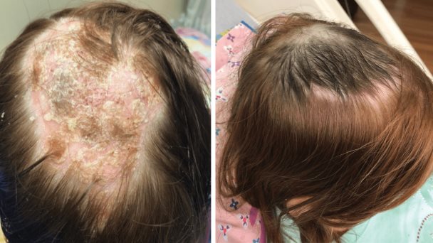 Medicamento causan alopecia psoriásica en paciente con enfermedad de crohn en Puerto Rico Medicamento causan alopecia psoriásica en paciente con enfermedad de crohn en Puerto Rico