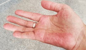 Mutación del lupus puede desbloquear fármacos dirigidos para un subconjunto de pacientes