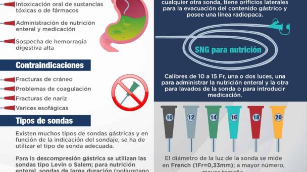 Sondaje Gastrico - Infografía Sondaje Gastrico - Infografía