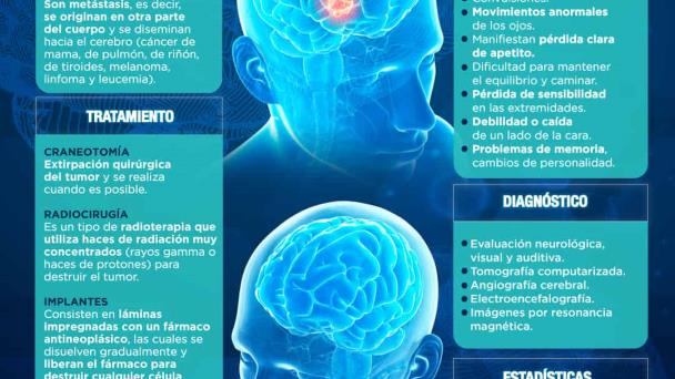 Tumores cerebrales - Infografía Tumores cerebrales - Infografía