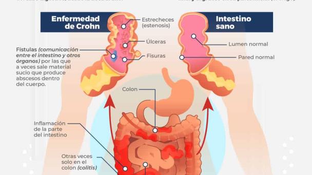 Enfermedad de Crohn - Infografía Enfermedad de Crohn - Infografía