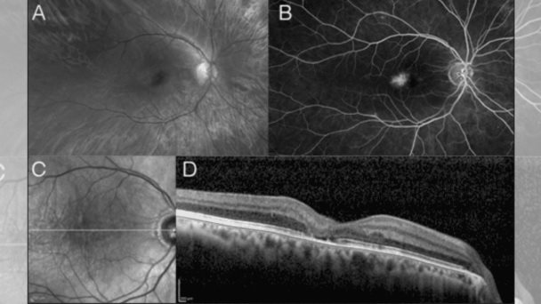 Estudio: Mayor prevalencia de diabetes en pacientes con telangiectasia macular tipo 2 en Puerto Rico Estudio: Mayor prevalencia de diabetes en pacientes con telangiectasia macular tipo 2 en Puerto Rico