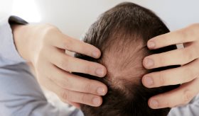 Las incógnitas de la pastilla milagrosa contra un tipo de calvicie