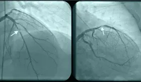 Se registra rara insuficiencia cardíaca en paciente con leucemia mieloide aguda en la Isla