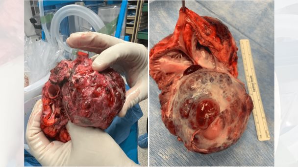 Salvan la vida de paciente con paraganglioma cardíaco en Puerto Rico Salvan la vida de paciente con paraganglioma cardíaco en Puerto Rico