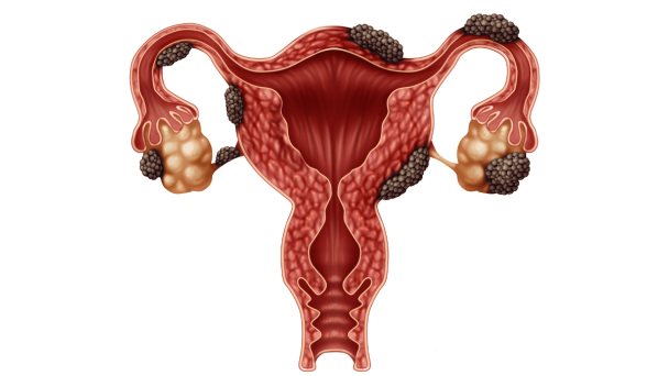 La terapia combinada con relugolix calma el dolor de la endometriosis La terapia combinada con relugolix calma el dolor de la endometriosis