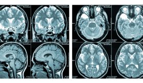 Neuroanatomía clínica de la Esclerosis Múltiple: perspectivas y avances clínicos