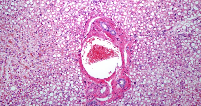 Hígado graso, la enfermedad sin síntomas que puede terminar causando cirrosis o cáncer