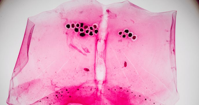 Gel berdazimer 10.3% muestra beneficio contra el molusco contagioso, según estudio Fase 3