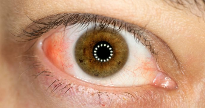 Sífilis: causa infecciosa más común en pacientes con escleritis en Puerto Rico, según estudio