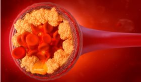 Hiperlipidemia: aumento en los depósitos grasos de las arterias, un riesgo silencioso