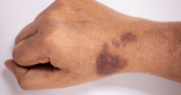 Terapia génica reduce las hemorragias en hemofilia, según investigadores