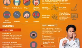 Sindrome de Sj&ouml;gren - Infograf&iacute;a