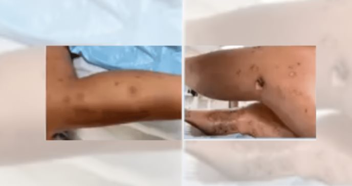 Se registra en Puerto Rico atípico caso de lupus en durante el periodo de postparto