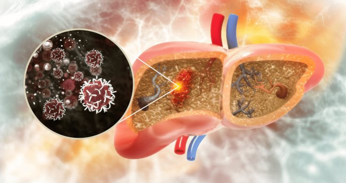 Un análisis de sangre podría diagnosticar EHNA y fibrosis, según estudio