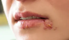 Las cuatro enfermedades de trasmisión sexual de las que el condón no te protege