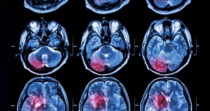 Mejores predicciones a largo plazo en sobrevivientes hemorragias intracerebrales e intraventriculares