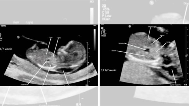 Higroma quístico del primer trimestre: Diagnóstico de hernia diafragmática congénita Higroma quístico del primer trimestre: Diagnóstico de hernia diafragmática congénita