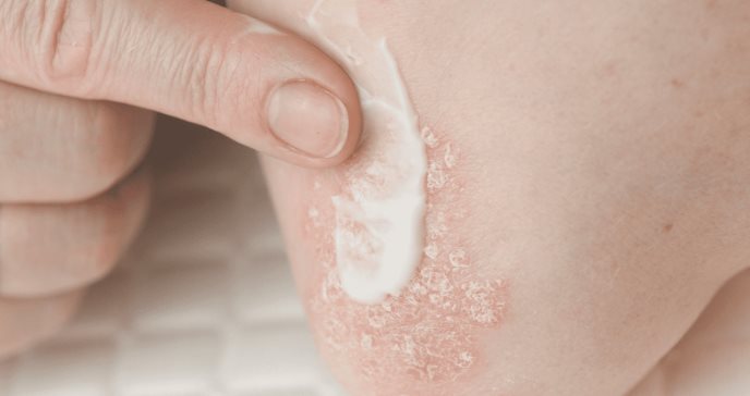 FDA aprueba Ustekinumab para Artritis Psoriásica en niños