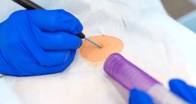 Estudio indica que una prueba cutánea identifica con precisión el Alzhéimer