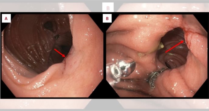 Hallan raro adenocarcinoma gástrico asociado con adenocarcinoma de páncreas de células en anillo de sello