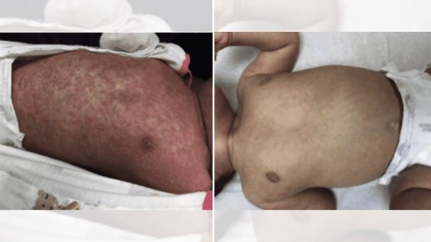Paciente pediátrico desarrolla eosinofilia a causa de sarna costrosa en Puerto Rico Paciente pediátrico desarrolla eosinofilia a causa de sarna costrosa en Puerto Rico