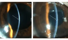 Desarrollan c&oacute;rnea de bioingenier&iacute;a que devuelve la vista a personas ciegas y con deficiencias visuales