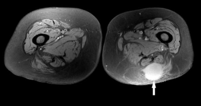 Revelan raro caso de metástasis en tejidos blandos de adenocarcinoma pancreático tras resección curativa