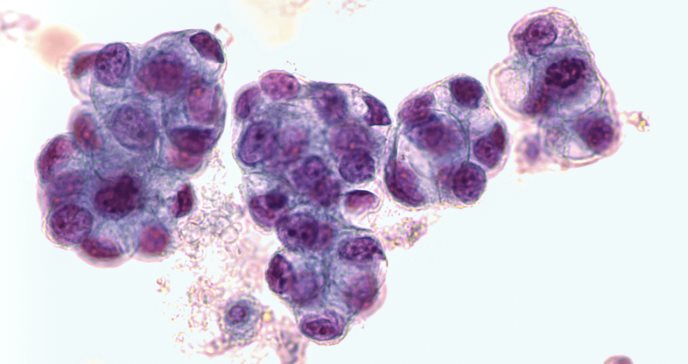 Científicos enfatizan la necesidad de realizar más estudios para tratar el cáncer de endometrio