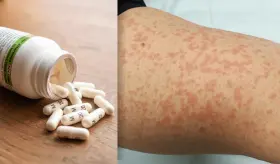 5 Datos que debes tener en cuenta sobre la alergia a la penicilina