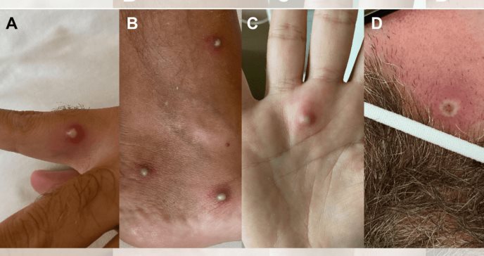 Detectada primera coinfección de VIH, Monkeypox y COVID-19 en Italia