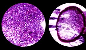 Completan el mapa genómico de la leucemia linfática crónica