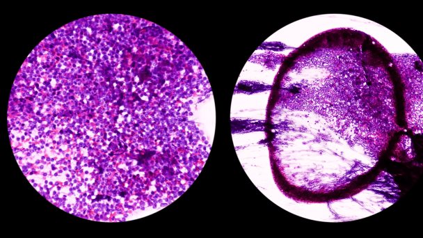 Completan el mapa genómico de la leucemia linfática crónica